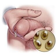 Chlamydial discharge