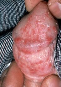 Discharge from the penis due to thrush
