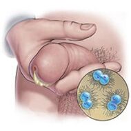 Gonorrhea discharge